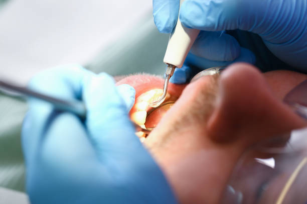 Best Emergency Wisdom Tooth Extraction in Pulaski, WI